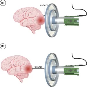 Revolutionizing Stroke Diagnosis